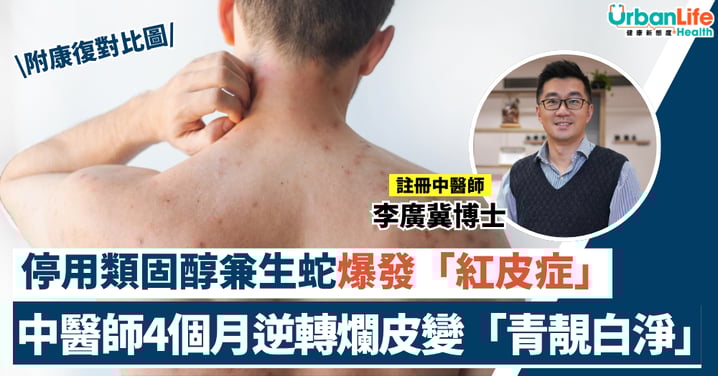 【濕疹實例】77歲伯伯停用類固醇爆發「紅皮症」？中醫師4個月逆轉爛皮變「青靚白淨」