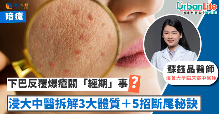 【暗瘡救星】下巴反覆爆瘡關「經期」事?浸大中醫拆解3大體質+5招斷尾護膚秘訣