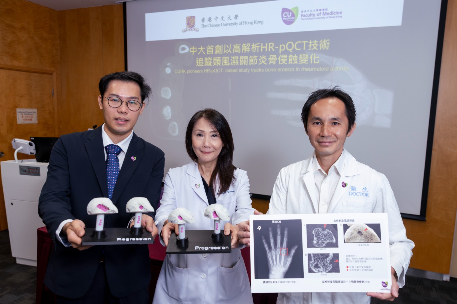 中大醫學院首創利用高解析度「HR-pQCT」技術追蹤類風濕關節炎骨侵蝕變化,不但可排除非炎症引起的小型骨侵蝕病徵;更可為初發病人精準診斷出微小病變,及早採取「達標治療」策略,病人骨侵蝕情況可保持穩定,甚至可逆轉關節損傷。
<br />
(左起)中大醫學院內科及藥物治療學系博士後研究員鄭梓灝博士;中大醫學院內科及藥物治療學系講座教授及風濕科主管譚麗珊教授;及中大醫學院內科及藥物治療學系風濕科臨床副教授蘇晧醫生。